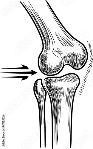 Anatomical of Human Knee Joint with Force Arrows Indicating Pressure anatomy bone