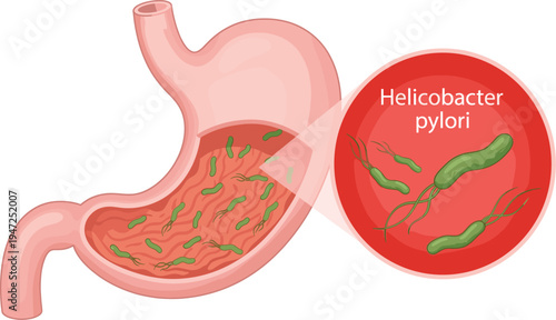 Helicobacter pylori bacteria in human stomach, gastric infection and peptic ulcer disease medical vector illustration
