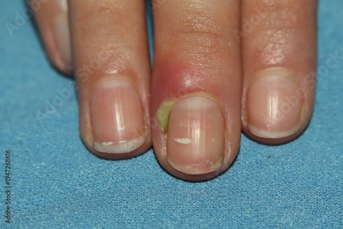 Acute paronychia infection on a fingernail with redness, swelling, and pus. Medical dermatology concept, nail fold inflammation, bacterial infection, pain, hygiene and treatment needs for healthcare.