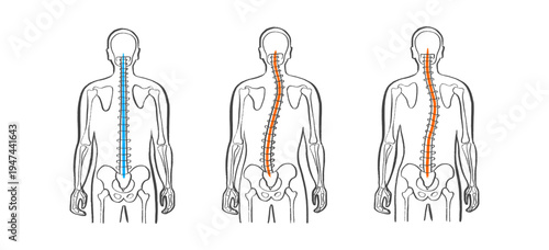 Scoliosis spine deformity