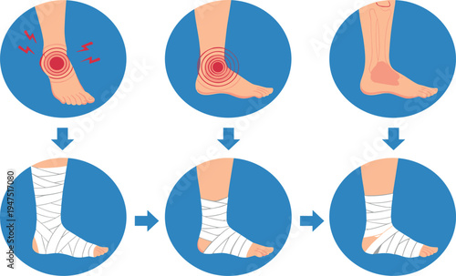Step-by-Step Illustration of Ankle Injury Treatment with Pain, Swelling, and Bandaging for First Aid, Healthcare, and Medical Content