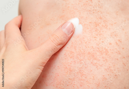 A mother's hand touches her child's back, where an allergy has developed.