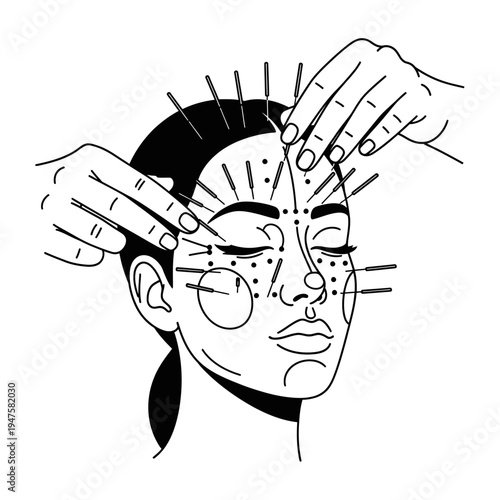 Facial acupuncture treatment illustrated with needles inserted into a woman s face