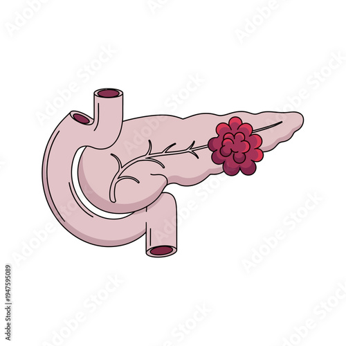 Illustration of the human pancreas with a highlighted cancerous tumor
