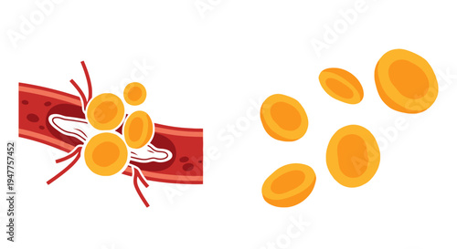 Illustrative Representation of Cholesterol Plaque Accumulation within a Human Artery, Visualizing the Mechanism of Atherosclerosis and its Progressive Impact on Cardiovascular Health