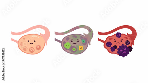 Illustrative guide to ovarian health depicting a healthy ovary, polycystic ovary syndrome (PCOS), and advanced disease with tumor. Essential for women's health education