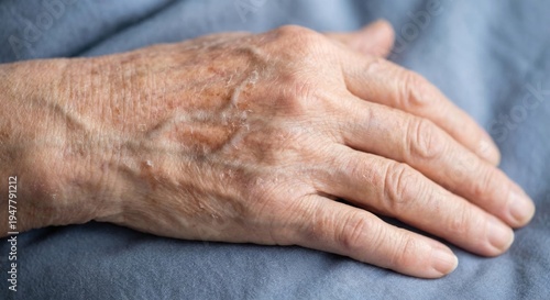 Elderly hand with dry aging skin and stasis dermatitis symptoms