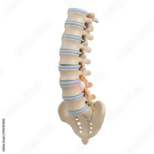 Human Spine Anatomical Model Highlighting Lumbar Disc Herniation And Pain