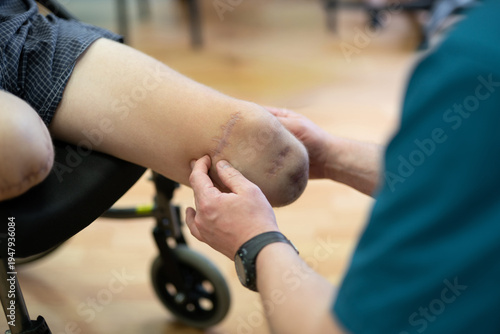 Schilderij op canvas Physical therapist examining a Ukrainian veteran's amputated leg in a clinic