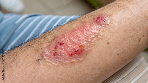 Close up of human skin with pressure ulcer on arm