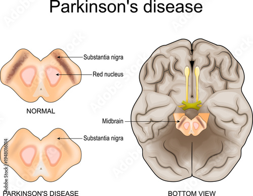 Substantia nigra and parkinsons disease. human brain.
