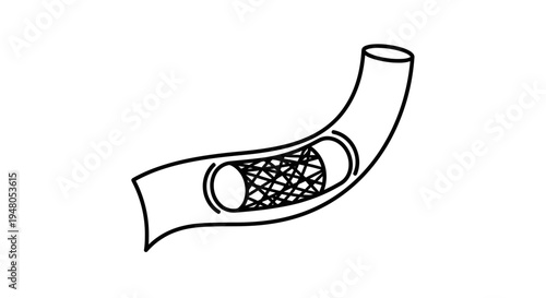 Medical Stent Insertion in Artery - Angioplasty Procedure Illustration