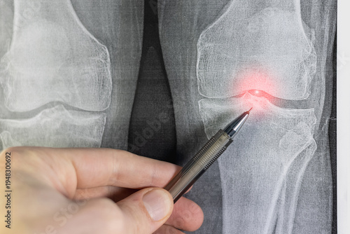 Doctor learn X-ray of knee joint arthritis. Medical scan.