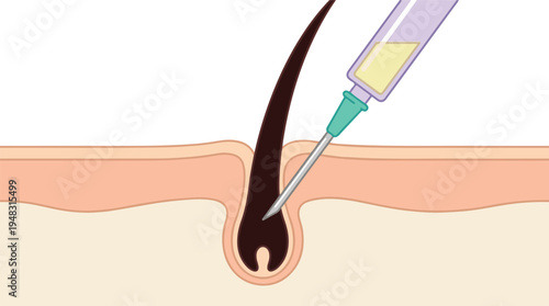 Hair follicle treatment with injection, dermatological procedure illustration