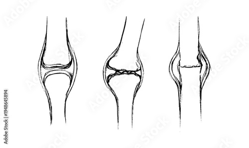 Arthritis Sketch Poster