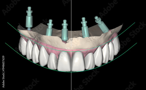 Computer aided dental implant design in dentistry. Digital smile design, Hollywood smile, digital implant planning, and computerized full arch prosthesis design.