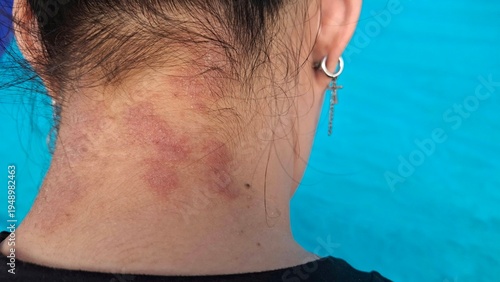 Bild auf Leinwand portrait the rash and hives, reaction and urticaria, eczema and epidermis, allergic and psoriasis, inflammation skin on the neck, health care and  medical concept