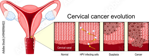 Cervical cancer evolution. Close-up of Normal cell, Human papillomavirus infection HPV infecting cells, Dysplasia and Cancer.