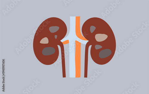 Stones in the kidney concept vector illustration.