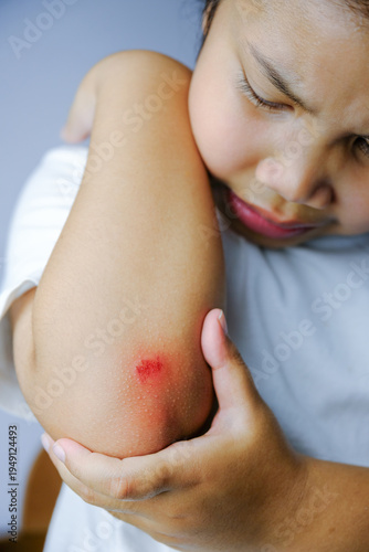 Close up of child elbow with painful skin abrasion and red wound. Concept of kids accident, first aid, healthcare and physical injury, vertical