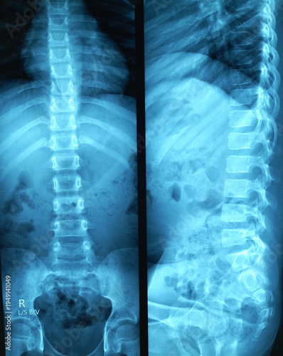 Konstfotografi X-ray of the human lumbo sacral spine