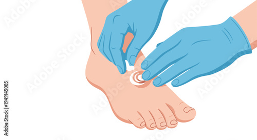 Gloved hands carefully apply a circular swirl of white cream onto a specific spot on a human foot.
