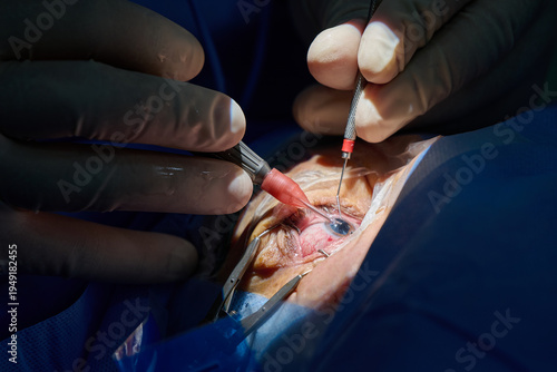 Foto Ophthalmic surgeon performing cataract surgery with intraocular lens implantation, close-up of eye microsurgery in operating room