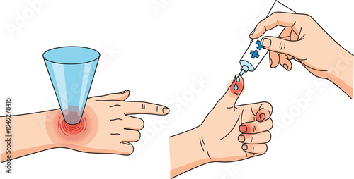 First Aid for Finger Injury Vector Featuring Hand Treatment with Ice Pack and Ointment Application for Wound Care