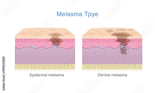 Skin layer with Epidermal melasma and Dermal melasma. Medical diagram about the different types of anatomy of skin pigment with dark spots problem and skin uneven.