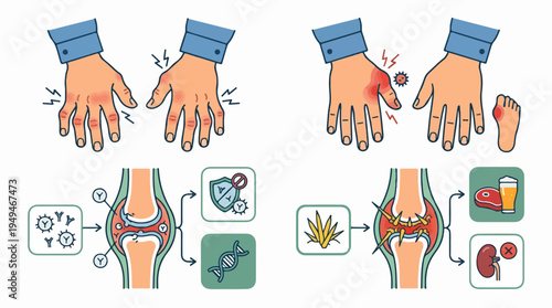 Rheumatoid Arthritis and Gout Comparison Infographic with Joint and Hand Symptoms.