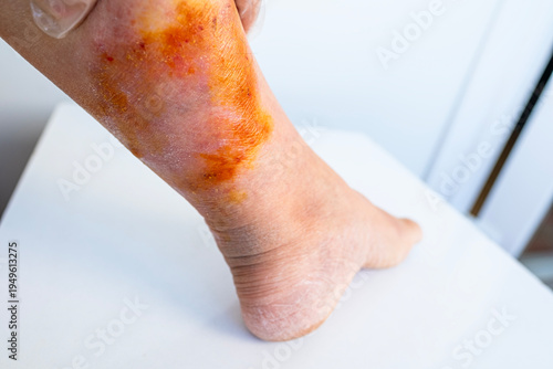 female leg with red jellyfish stings. Painful marine encounter. Beach safety awareness. Medical emergency on vacation. Ocean hazards, Vacation interrupted, stinging cells