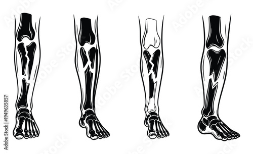 Leg fractures vector illustration, set of various types of human leg bone breaks