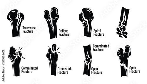 Set of human bone fracture types including transverse oblique spiral greenstick and comminuted