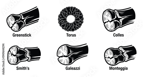 Common types of bone fractures with names including greenstick torus colles smiths galeazzi and monteggia