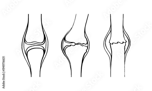 Arthritis Sketch Poster