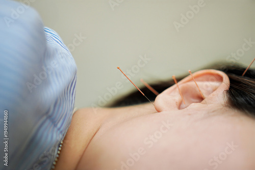 Quadro su tela Auricular Acupuncture Therapy on Ear