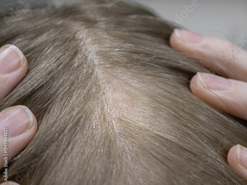 Baldness at the parting, a woman loses hair on her head