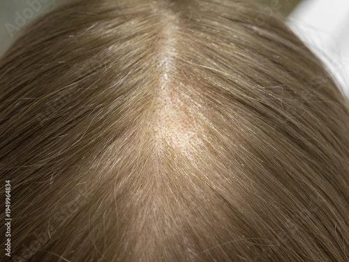 Androgenetic alopecia in women, hair loss around the parting