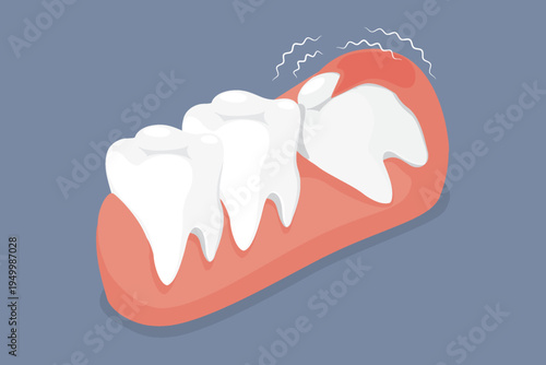 Illustration depicting a partially impacted wisdom tooth. Dental care concept. 3d isometric flat vector illustration.