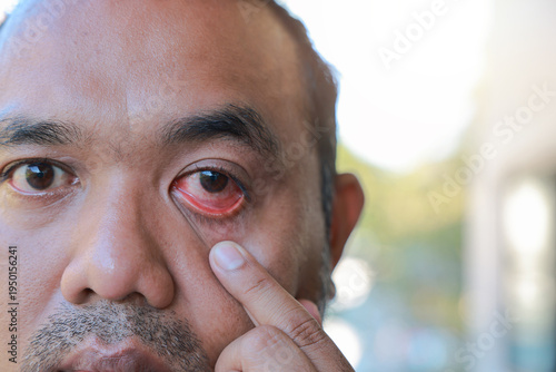 Foto Close up of an Asian man pulling down his lower eyelid with his finger to show a red, bloodshot and inflamed eye