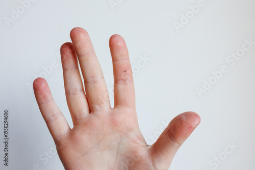 Obraz na plátně Child hand showing splinter in finger dry skin irritation dermatology concept