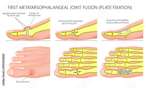 Hallux rigidus treatment. Joint fusion. Plate fixation
