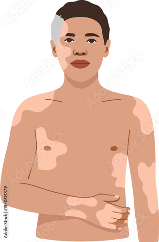 Vector Illustration of a Confident Men with Vitiligo for Awareness