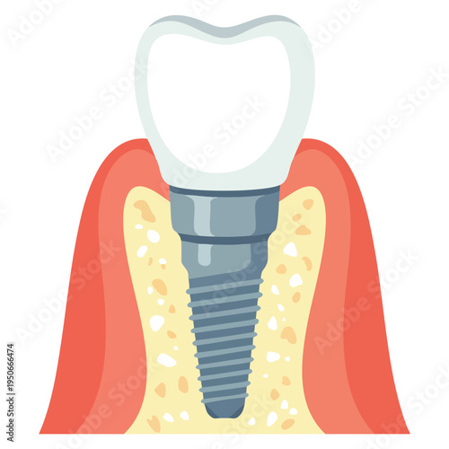Tooth with implant illustration ideal for dental clinic oral health treatment and medical care themed artwork