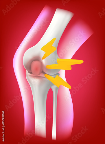 vector 3D of human knee joint in a lateral profile view realistic white bones distinct contours significant area acute pain and inflammation indicated prominent