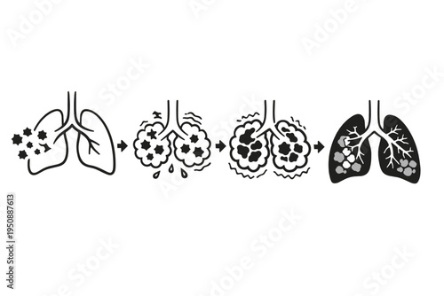 Vector illustration of silicosis progression stages, showing inhaled silica dust particles causing inflammation, fibrosis, and severe lung damage from occupational respiratory disease exposure.