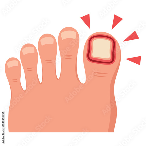 Person feet with swollen toe nail disease infection onychomycosis fungus on fingers cartoon vector illustration ideal for medical health awareness design