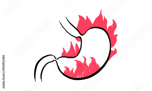 Gastroesophageal reflux pain