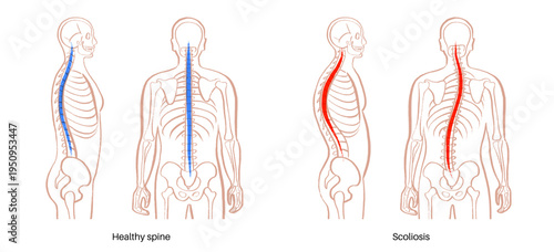Scoliosis spine deformity