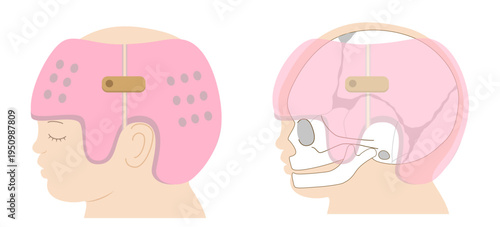 Diagram showing the mechanism of infant cranial correction with helmet therapy